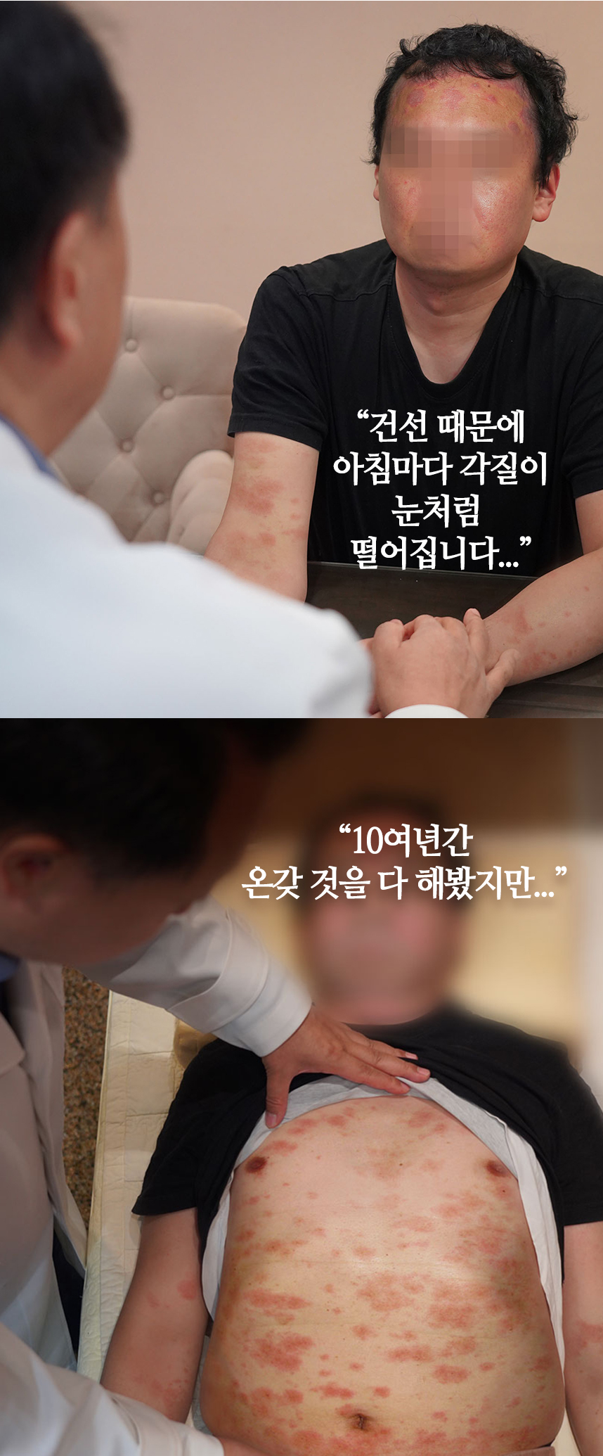건선 사례1