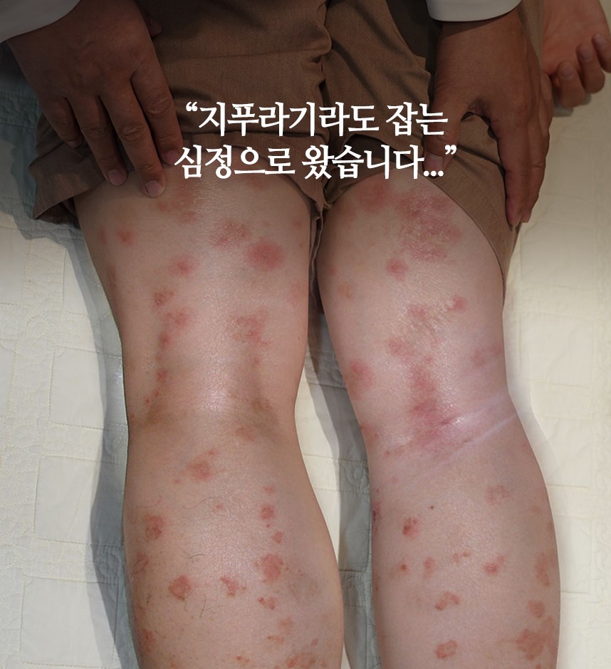 건선 사례1