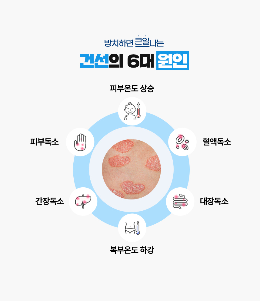The Six Major Causes of Psoriasis