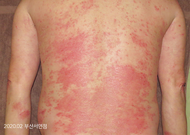 Before Treatment of Psoriasis