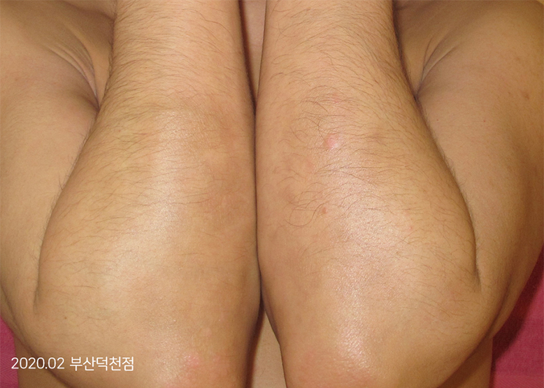 After Treatment of Psoriasis