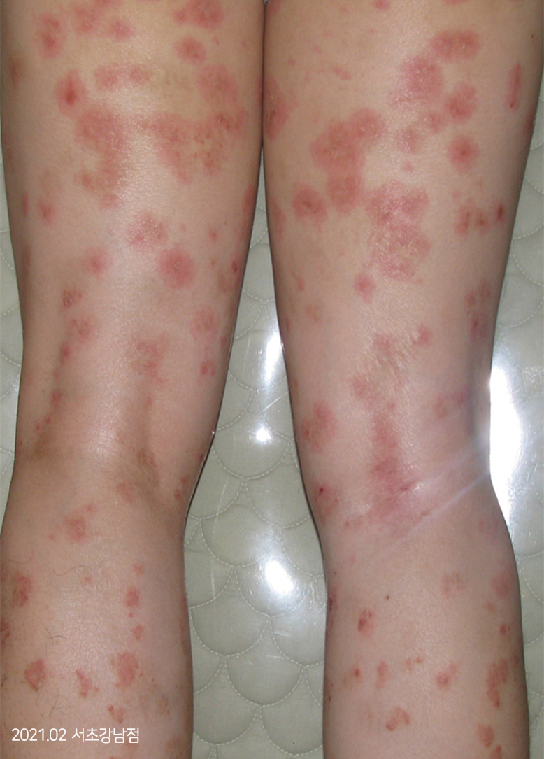 Before Treatment of Psoriasis