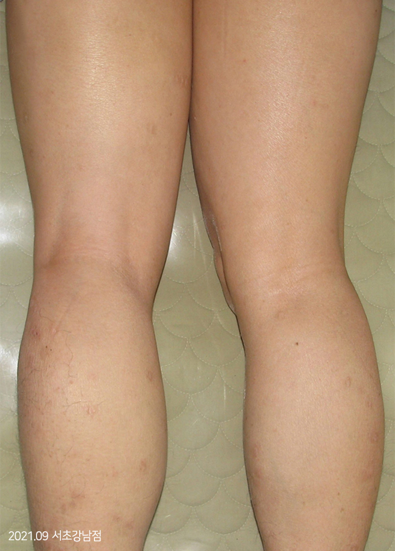 After Treatment of Psoriasis
