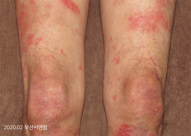 Before Treatment of Psoriasis