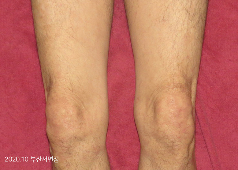 After Treatment of Psoriasis