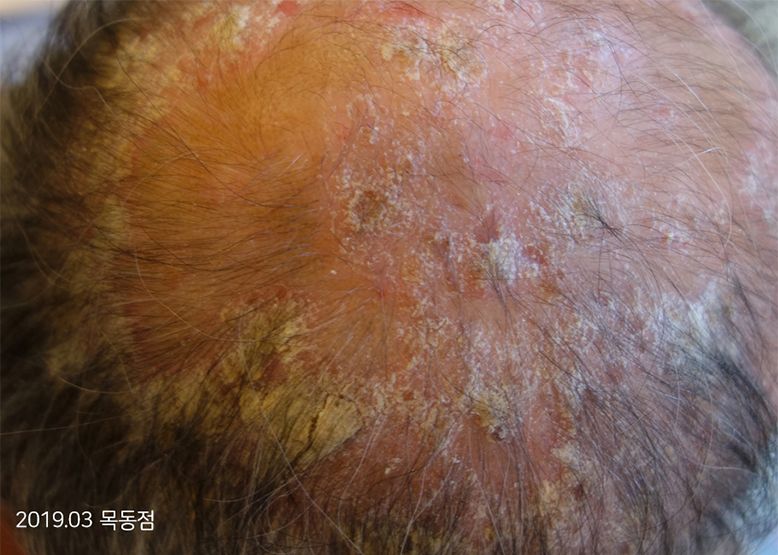Before Treatment of Psoriasis