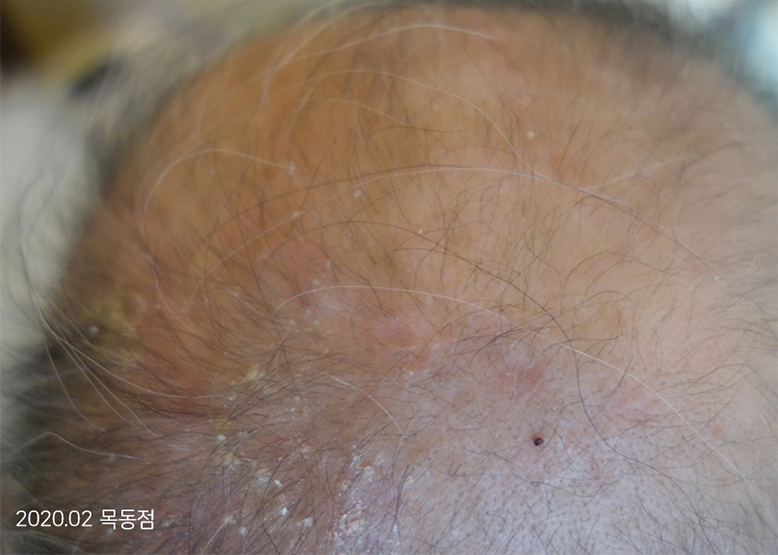 After Treatment of Psoriasis