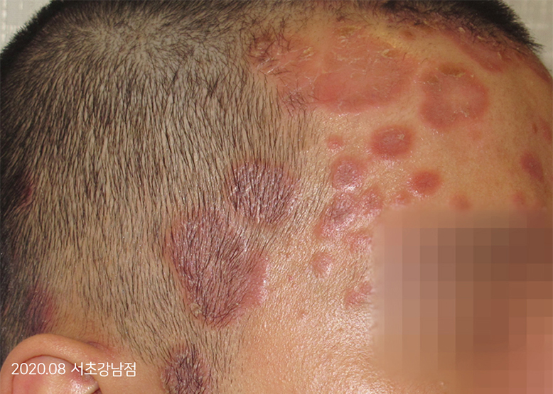 Before Treatment of Psoriasis
