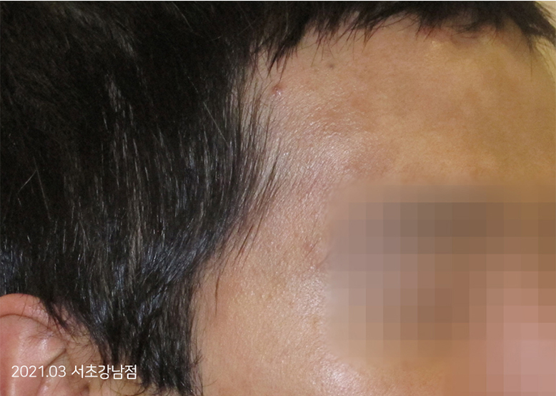 After Treatment of Psoriasis