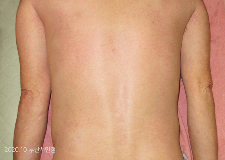 After Treatment of Psoriasis
