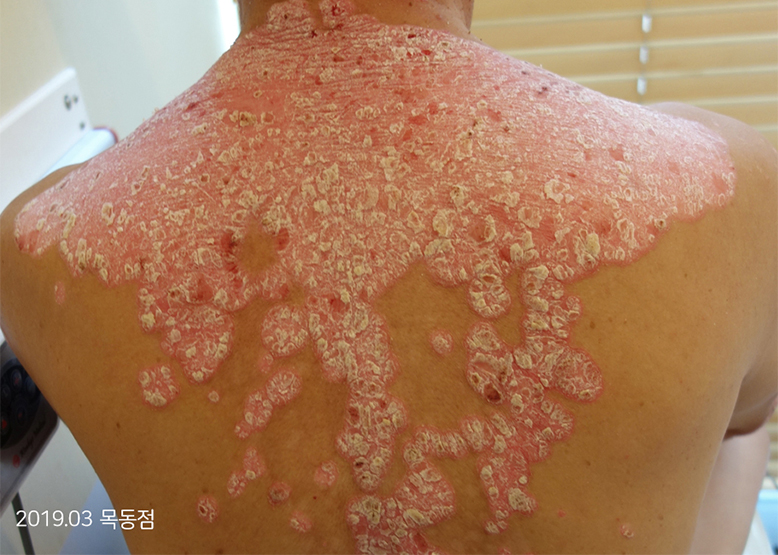 Before Treatment of Psoriasis