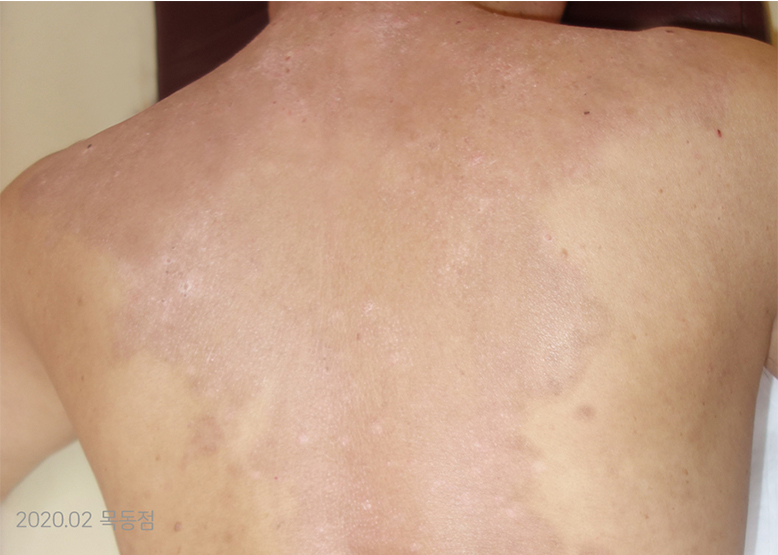 After Treatment of Psoriasis