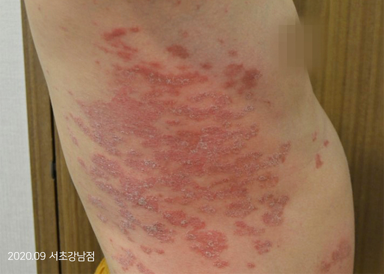 Before Treatment of Psoriasis