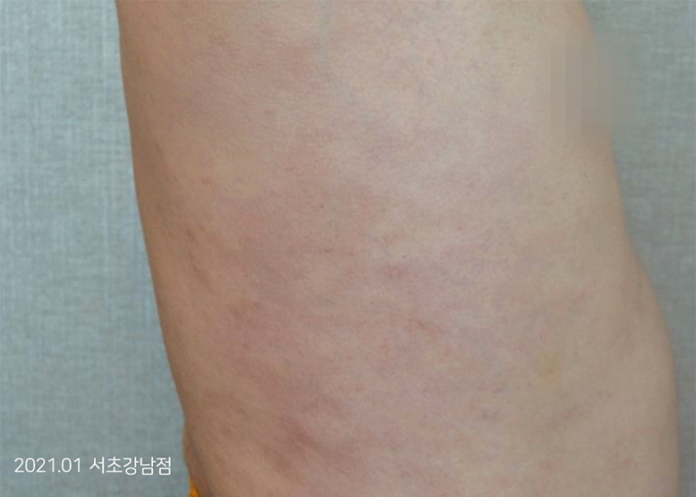 After Treatment of Psoriasis