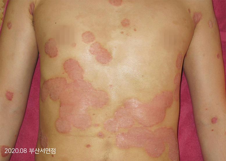 Before Treatment of Psoriasis