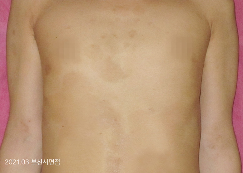 After Treatment of Psoriasis
