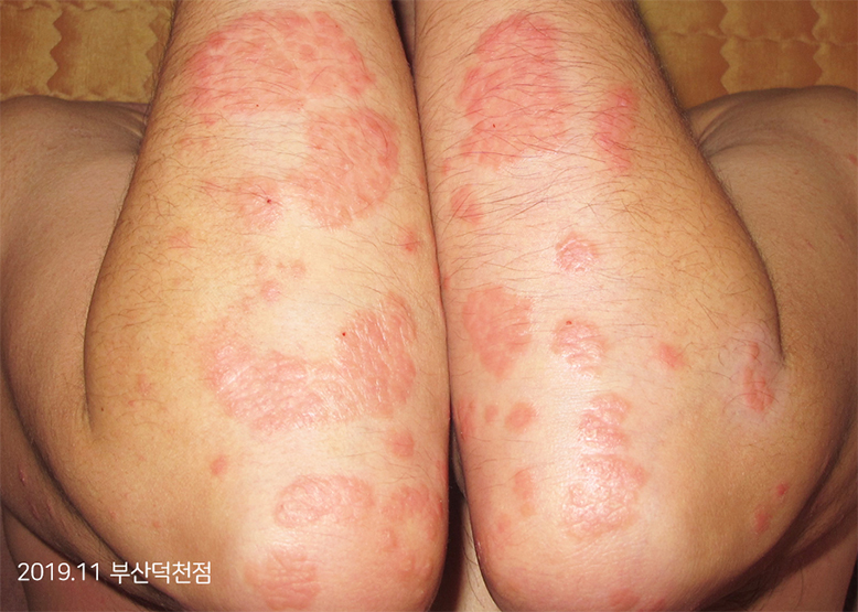 Before Treatment of Psoriasis
