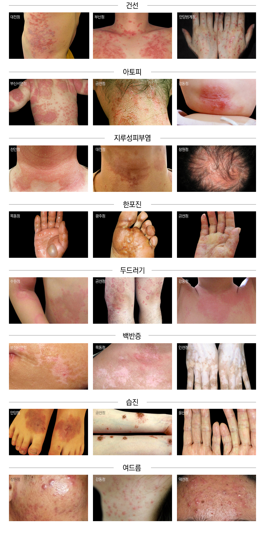 실제 두드러기 환자 사례로 보는 두드러기 치료