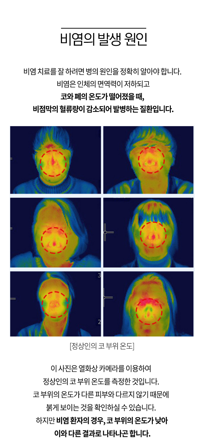 비염의 발생 원인 비염은 인체의 면역력이 저하되고 코와 폐의 온도가 떨어졌을 때, 비점막의 혈류량이 감소되어 발병하는 질환입니다. 이 사진은 열화상 카메라를 이용하여 정상인의 코 부위 온도를 측정한 것입니다. 코 부위의 온도가 다른 피부와 다른 피부와 다르지 않기 때문에 붉게 보이는 것을 확인하실 수 있습니다. 하지만 비염 환자의 경우, 코 부위의 온도가 낮아 이와 다른 결과로 나타나곤 합니다.