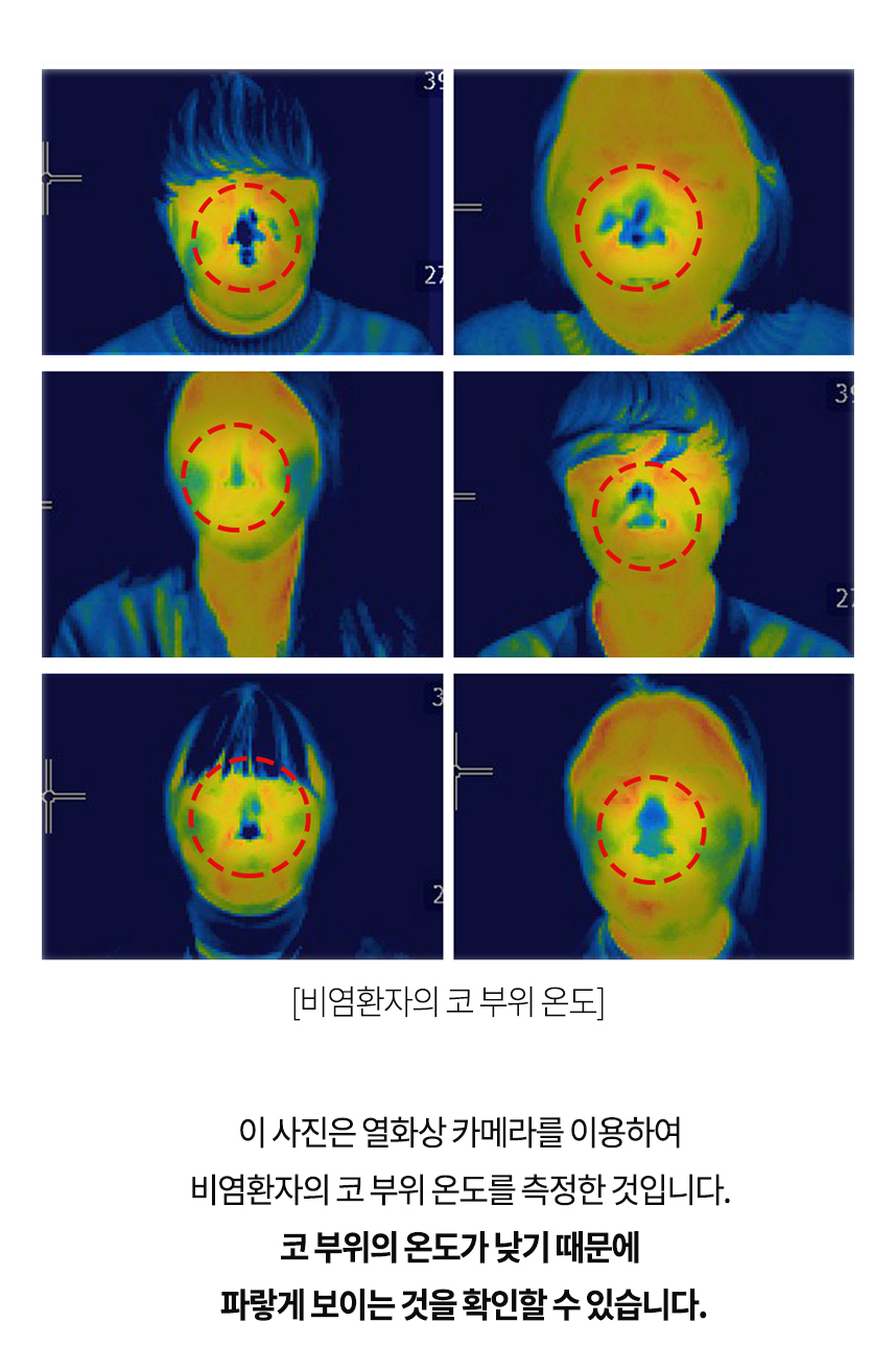 이 사진은 열화상 카메라를 이용하여 비염환자의 코 부위 온도를 측정한 것입니다. 코 부위의 온도가 낮기 때문에 파랗게 보이는 것을 확인할 수 있습니다.