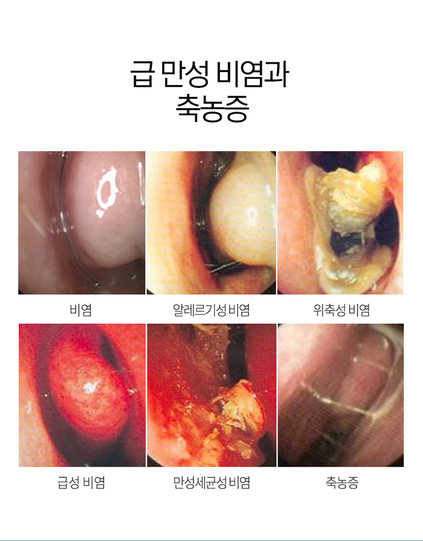 급 만성 비염과 축농증