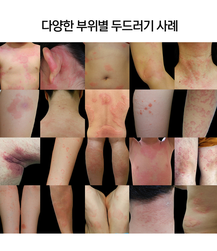 다양한 부위별 두드러기 사례