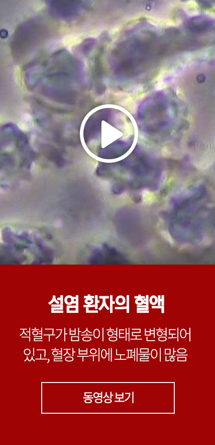 설염, 설궤양 환자의 혈액 : 적혈구가 밤송이 형태로 변형되어 있고, 혈장 부위에 노폐물이 많음 - 동영상 보기