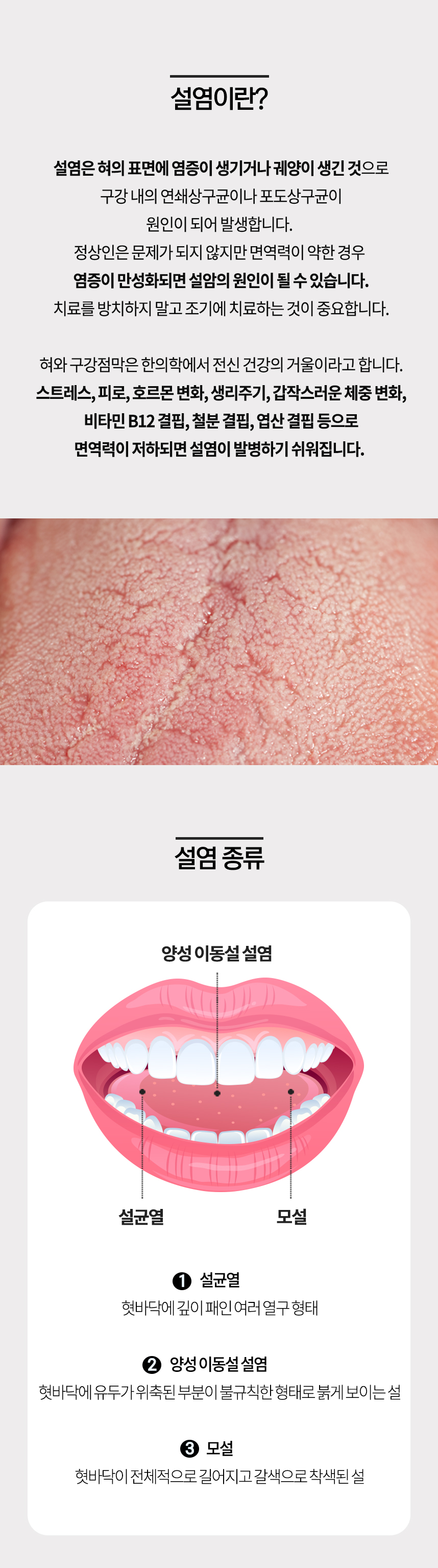 설염이란? 설염 종류