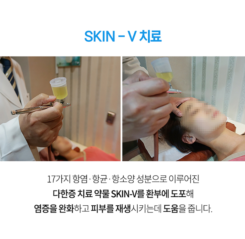 다한증 치료 약물 SKIN-V 치료 접촉성피부염과 고체온 면역증강요법