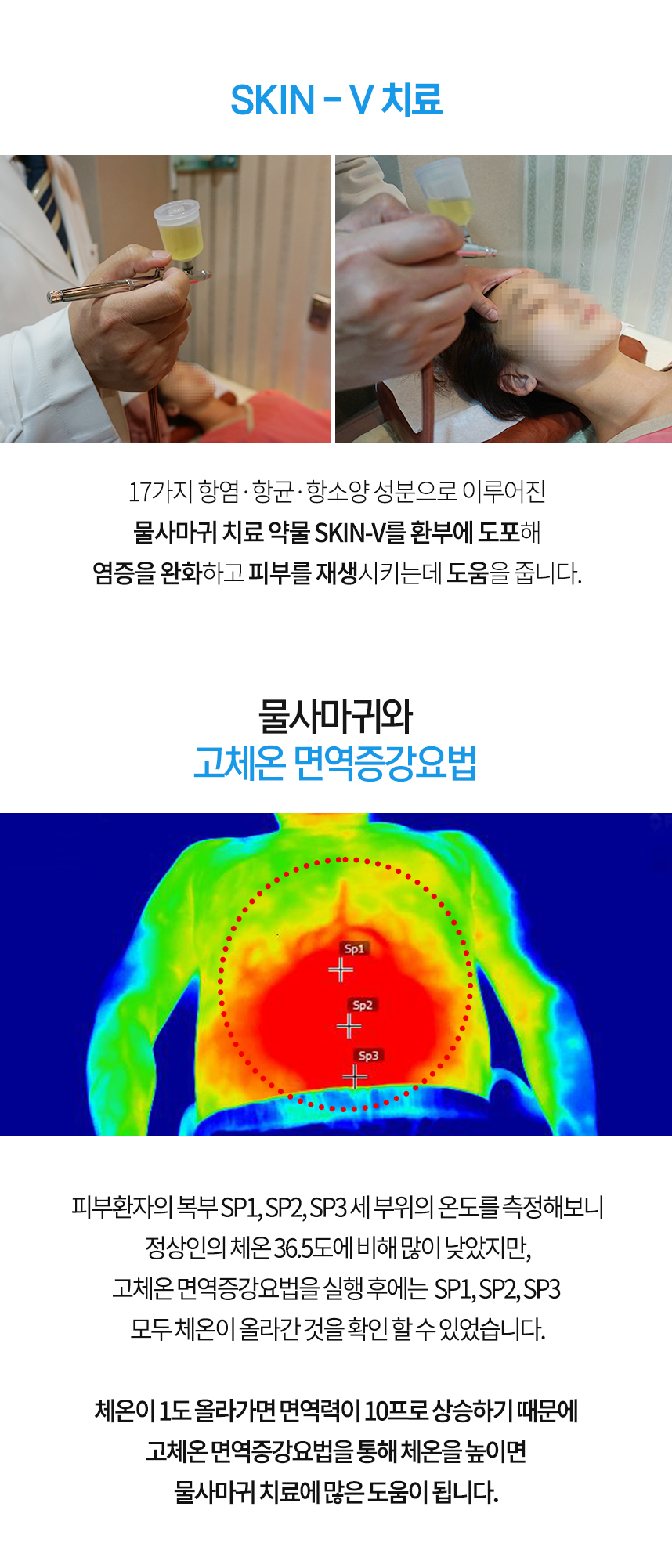 물사마귀 치료 약물 SKIN-V 치료 물사마귀와 고체온 면역증강요법