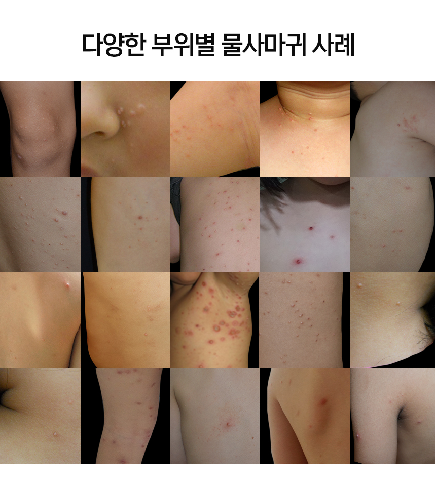 다양한 부위별 물사마귀 사례