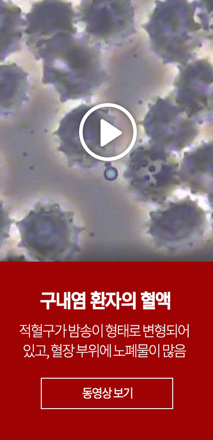 구내염, 구내궤양 환자의 혈액 : 적혈구가 밤송이 형태로 변형되어 있고, 혈장 부위에 노폐물이 많음 - 동영상 보기