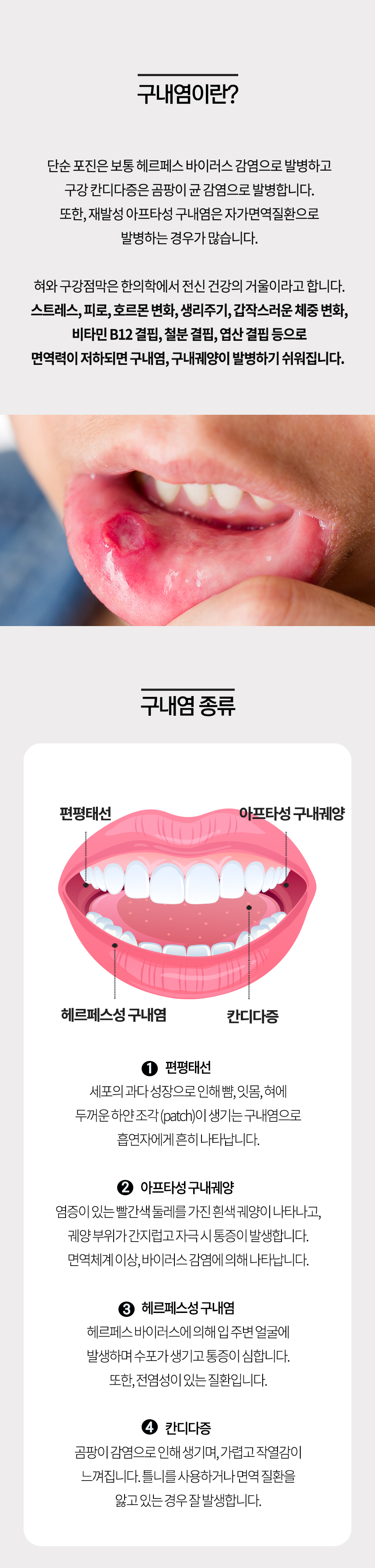 구내염이란? 구내염 종류
