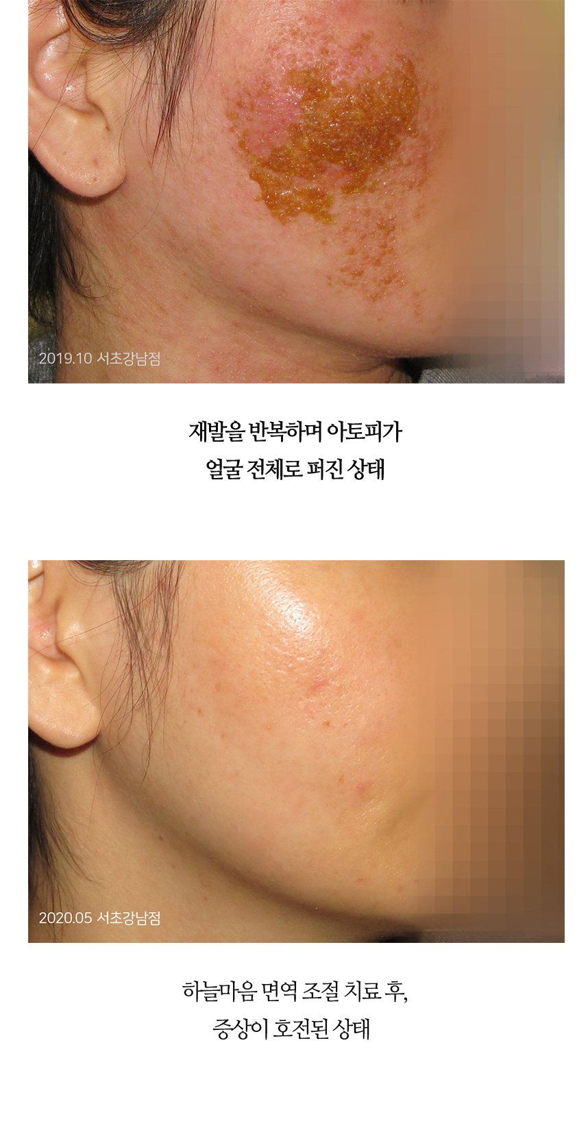 치료전후 이미지1