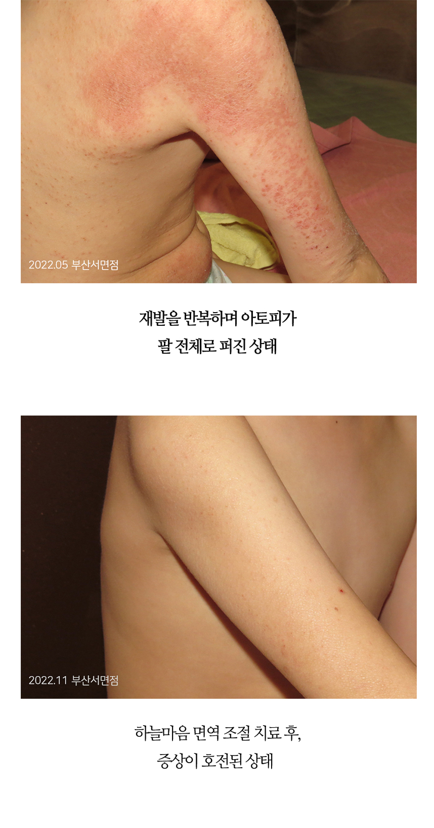 치료전후 이미지2