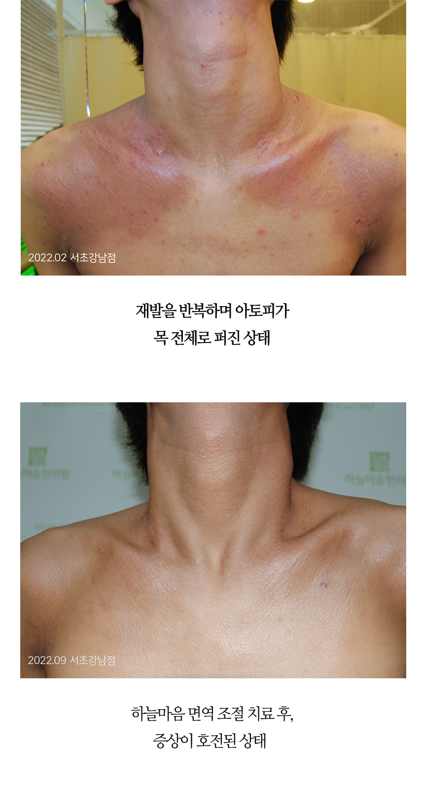 치료전후 이미지3