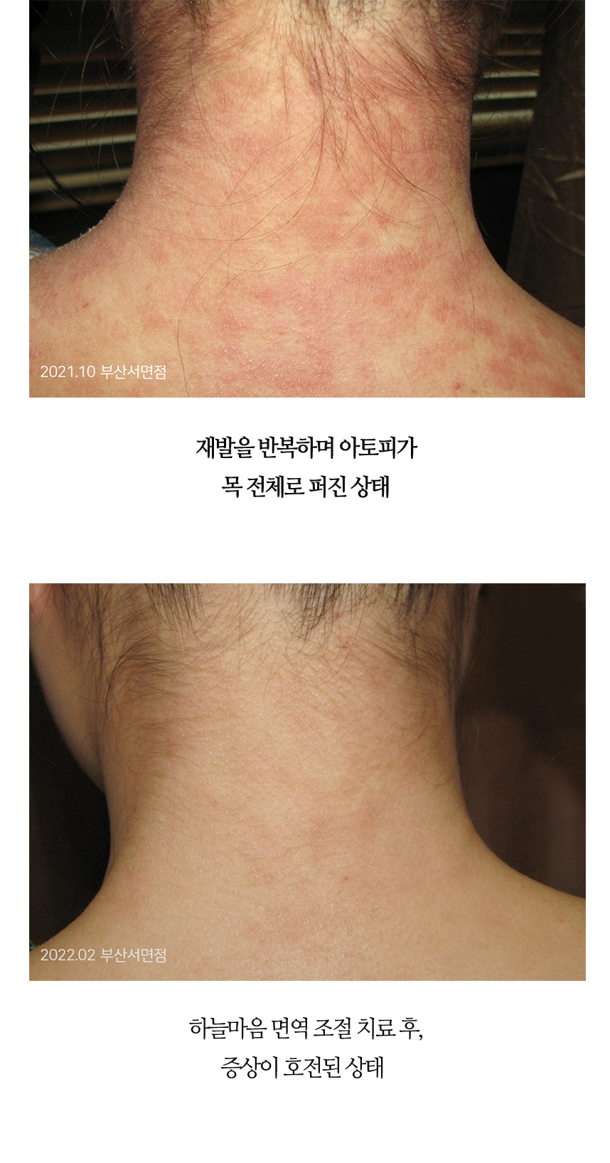 치료전후 이미지4