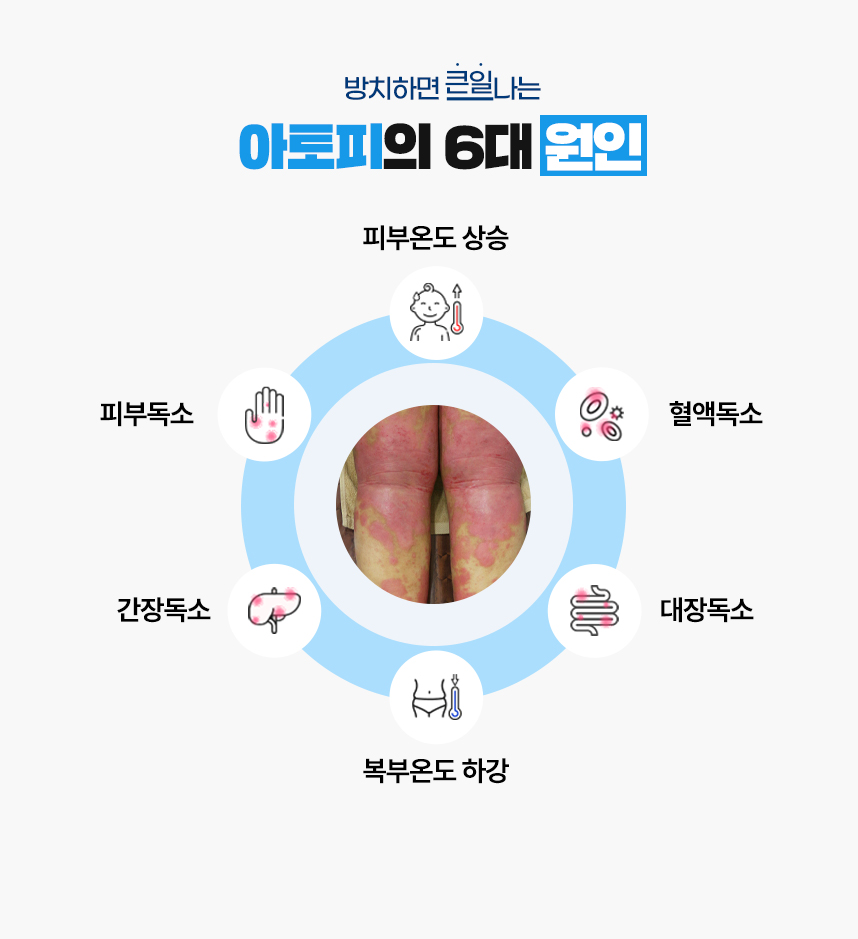 또한 아토피 증상이 있는 피부 온도는 높게 상승되어 있고 복부 온도는 낮게 하강되어 있는 병리적인 특성이 있어 이 6가지를 아토피가 발병하는 6대 원인으로 보고 있습니다.