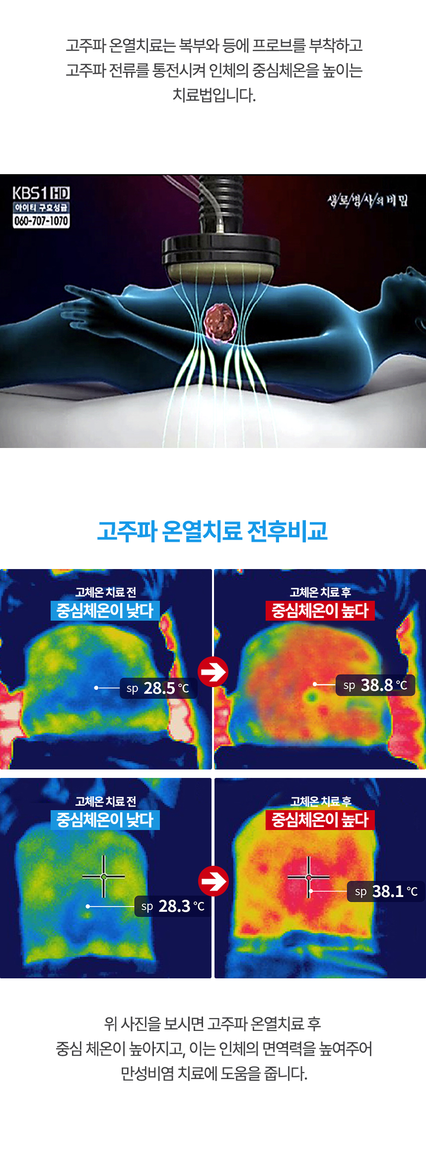 고주파 온열치료 후 중심체온이 높아지고 면역력을 높여주어 비염 치료에 도움을 줍니다.