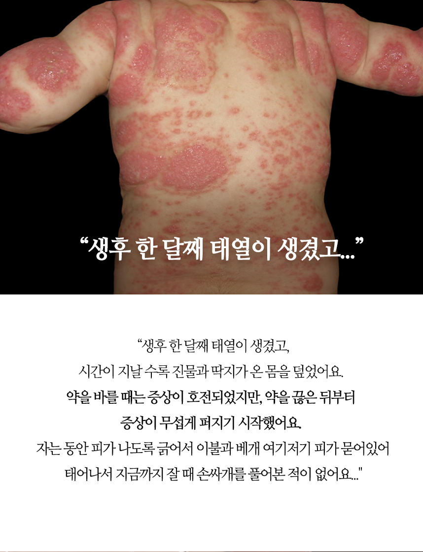 생후 한 달째 태열이 생겼고.... 