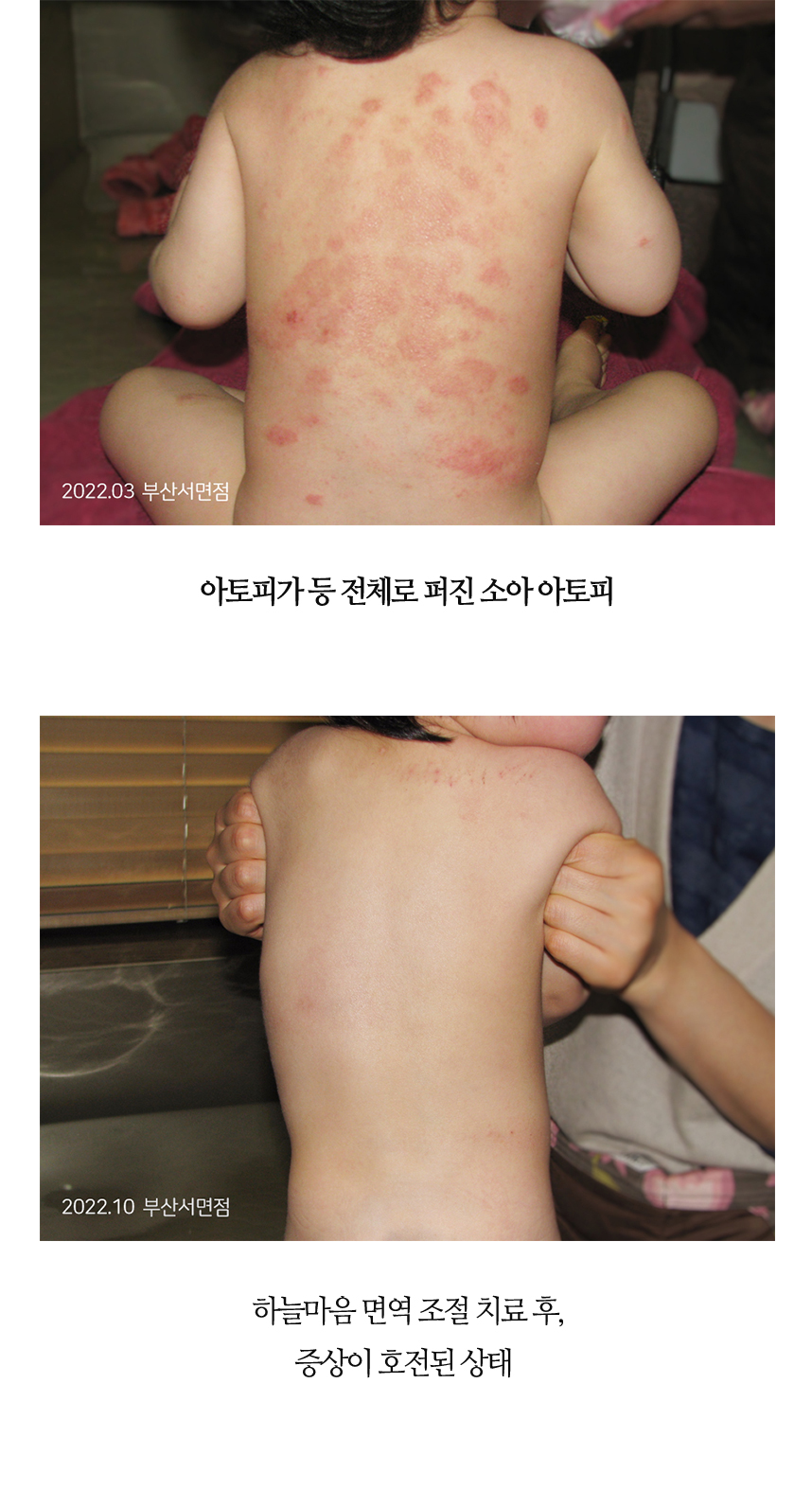 치료전후 이미지6