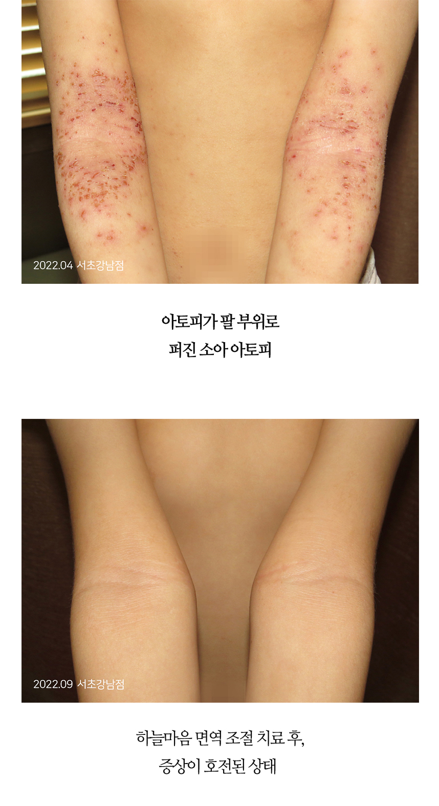 치료전후 이미지8