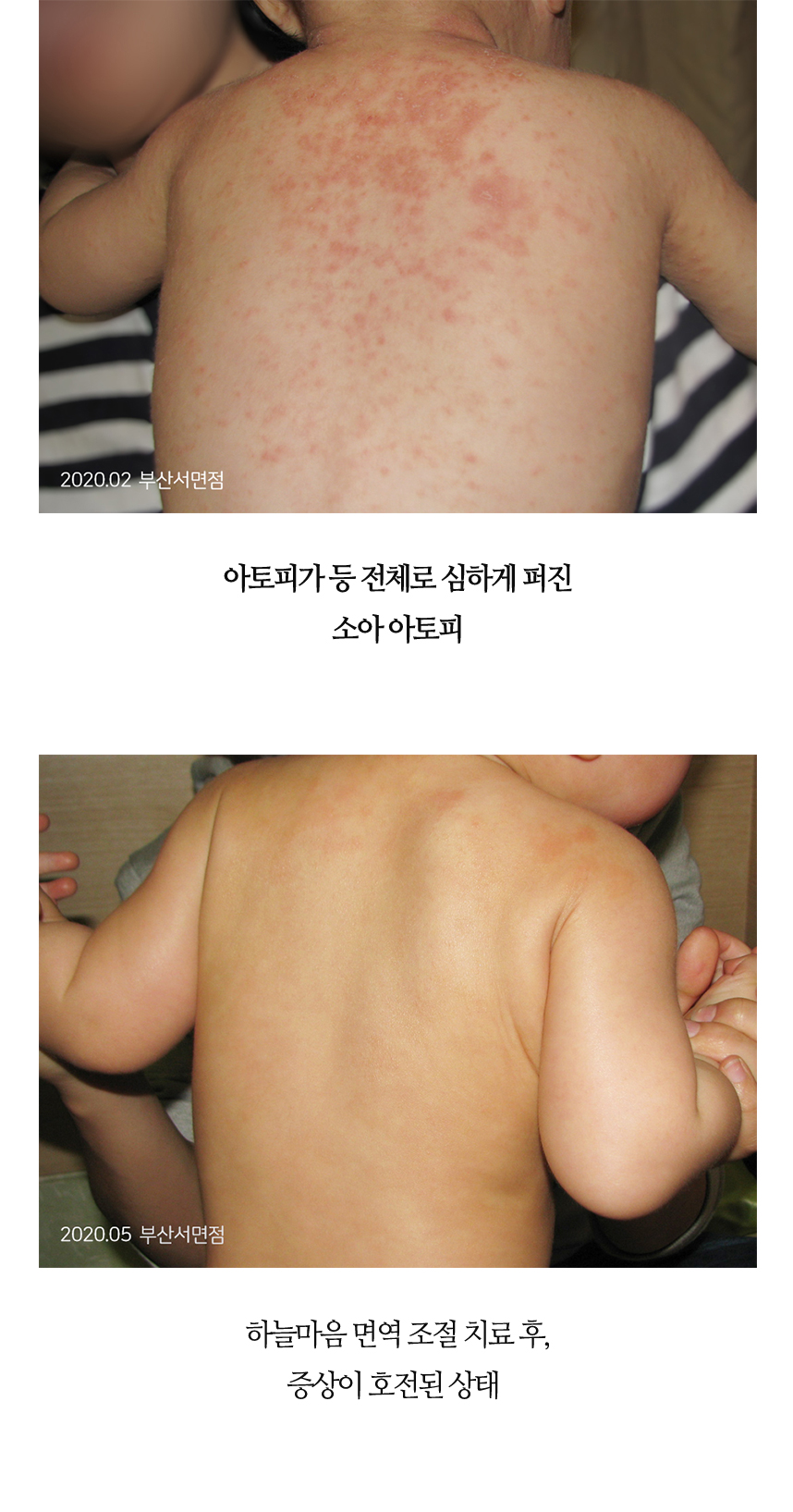 치료전후 이미지9