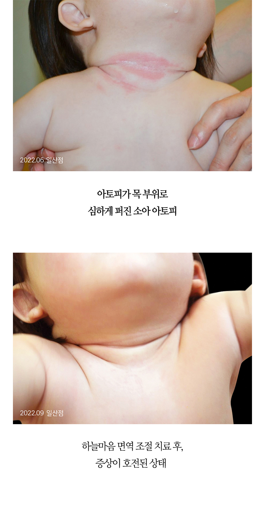 치료전후 이미지10