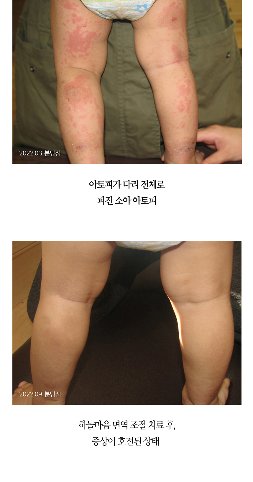 치료전후 이미지11
