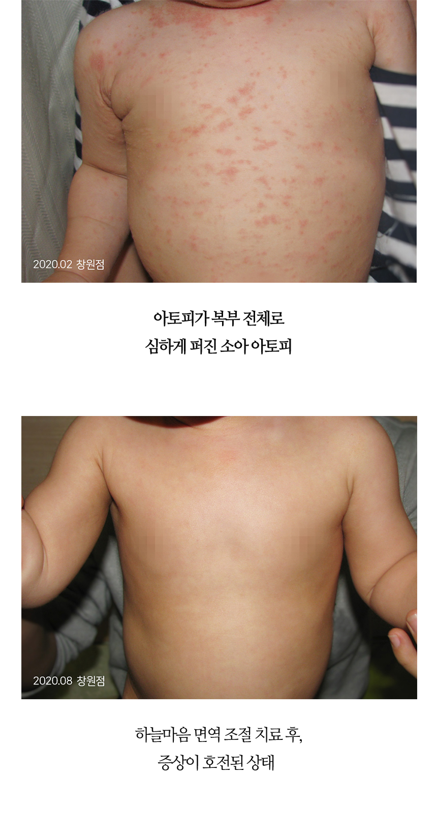 치료전후 이미지12