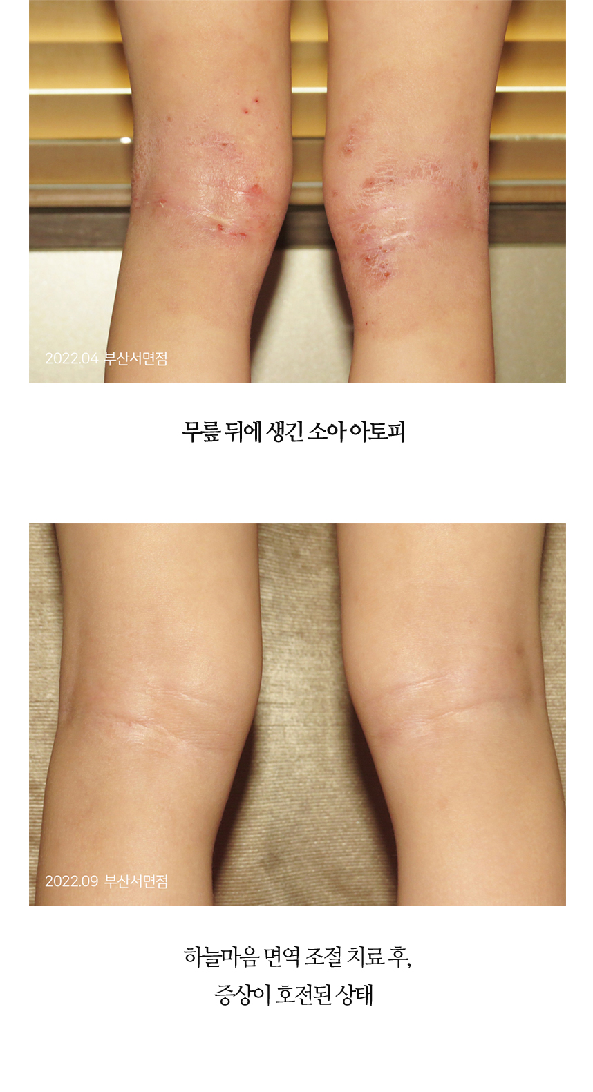 치료전후 이미지13