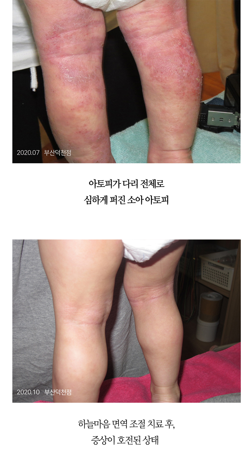 치료전후 이미지14