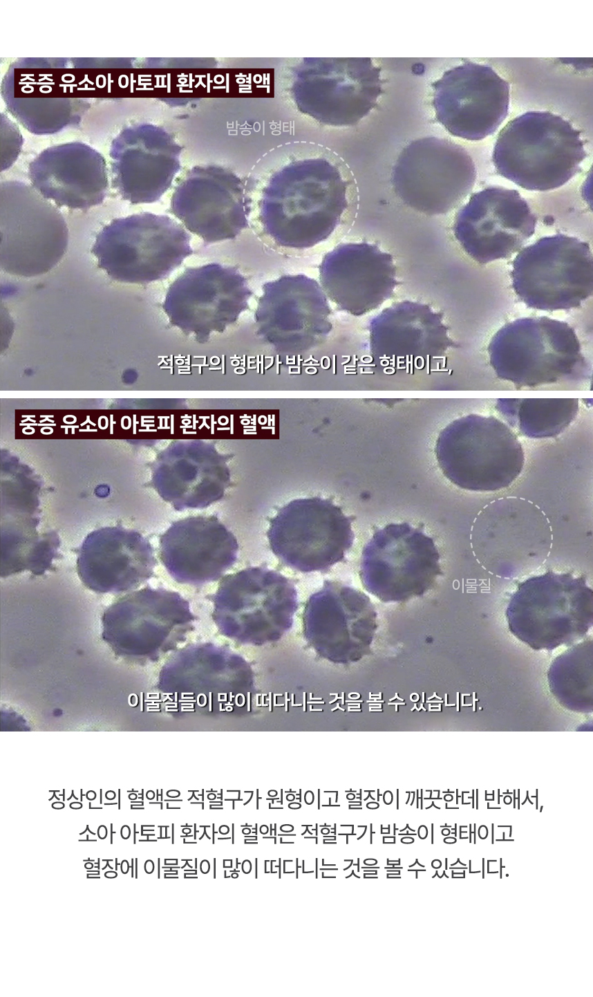 정상인의 혈액은 적혈구가 원형이고 혈장이 깨끗한데 반해서, 아토피 환자의 혈액은 적혈구가 밤송이 형태이고 혈장에 이물질이 많이 떠다니는 것을 볼 수 있습니다.