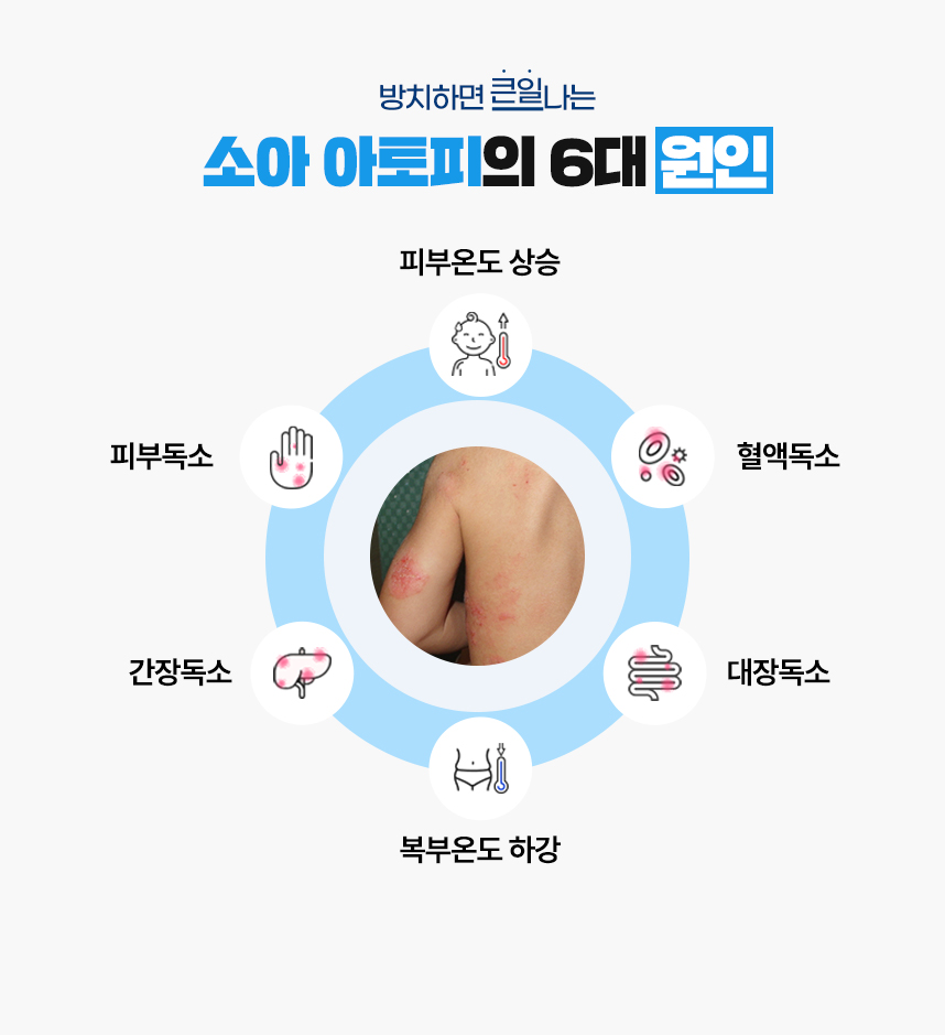 또한 아토피 증상이 있는 피부 온도는 높게 상승되어 있고 복부 온도는 낮게 하강되어 있는 병리적인 특성이 있어 이 6가지를 아토피가 발병하는 6대 원인으로 보고 있습니다.